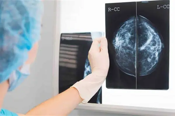 Cáncer de mama se presenta cada vez a menor edad