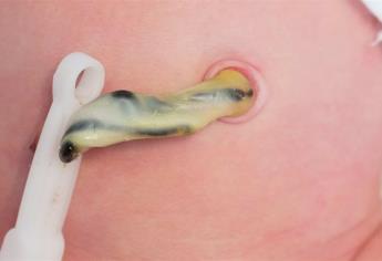 Descubren células de cordón umbilical para tratamiento de leucemia
