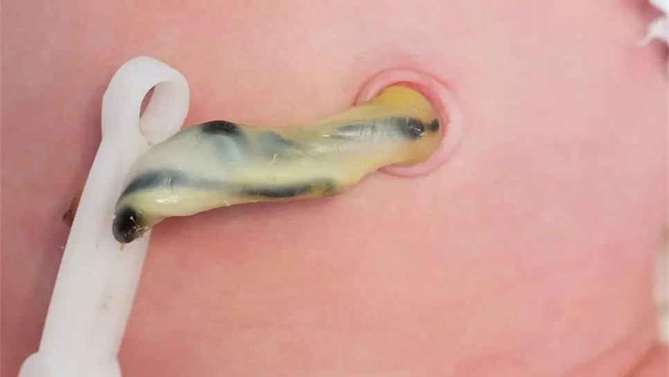 Cordón umbilical.