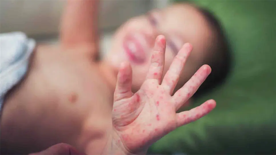 Registra México 81 casos de sarampión