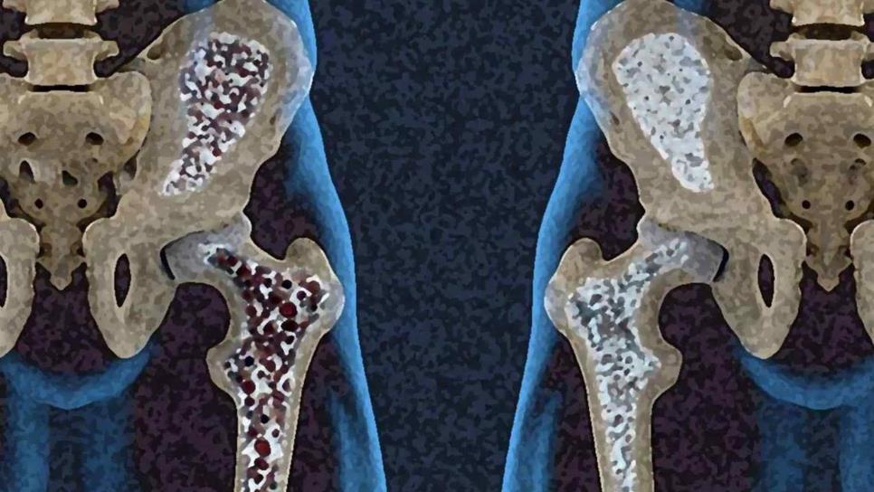 Esto es lo que debes saber acerca de la osteoporosis