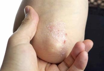 Expertos explican cómo la psoriasis afecta a la piel