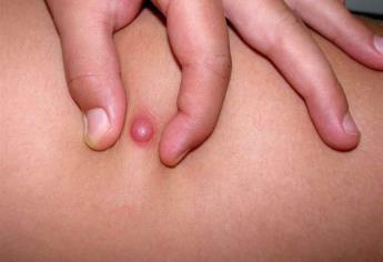 La dermatofibrosarcoma protuberans, un cáncer poco frecuente