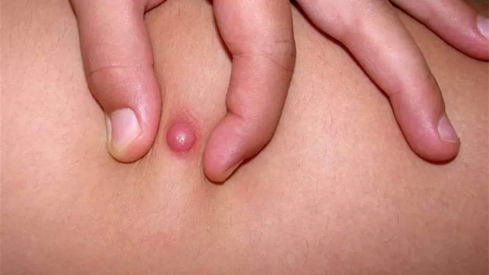Dermatofibrosarcoma protuberans. FOTO: Internet