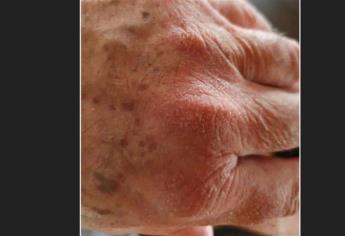 Lavado excesivo de manos puede generar dermatitis