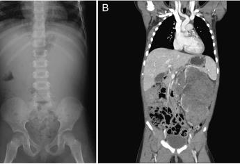 ¿Qué es el tumor de Wilms?