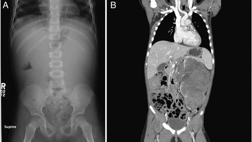 ¿Qué es el tumor de Wilms?