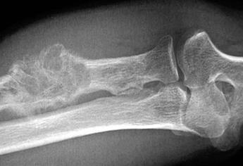 IPN desarrolla prueba para detectar cáncer de huesos