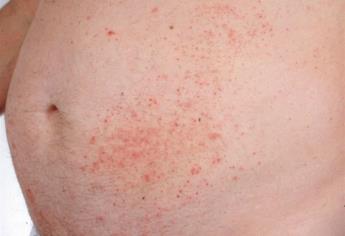 ¿Cómo es la dermatitis exfoliativa?