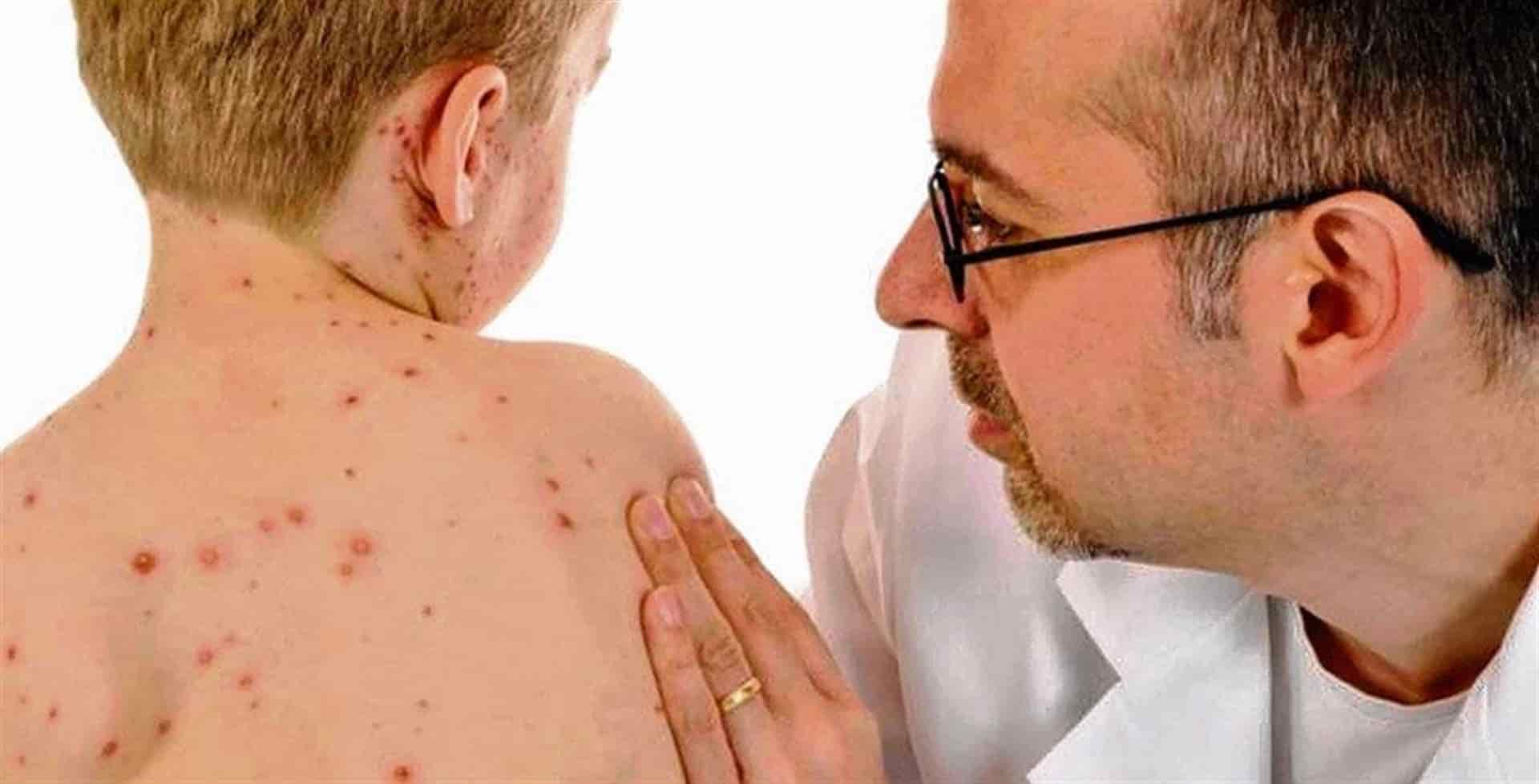 La sana distancia también puede evitar el sarampión