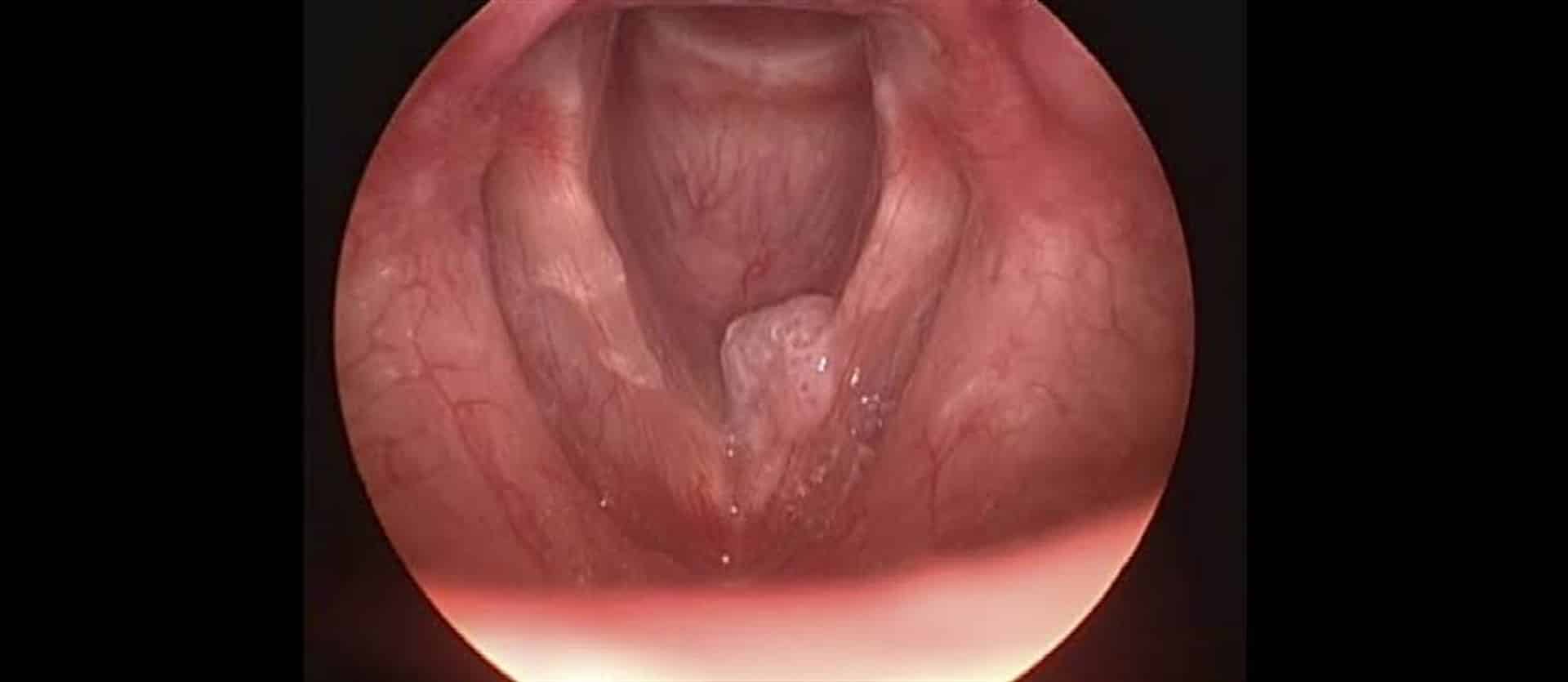 ¿Qué es la papilomatosis respiratoria?