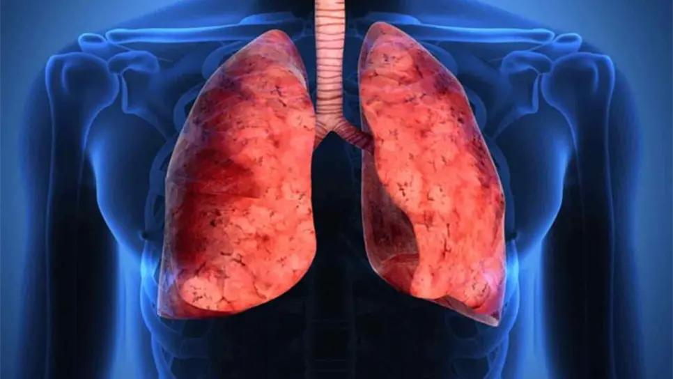 Hospital General de Los Mochis registra dos casos de tuberculosis