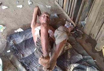 Don Manuel tiene lepra, dejó de recibir medicamento por la pandemia y se agravó