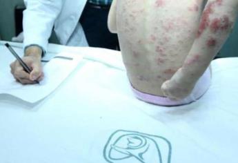 Choix, municipio con más casos de lepra en todo Sinaloa