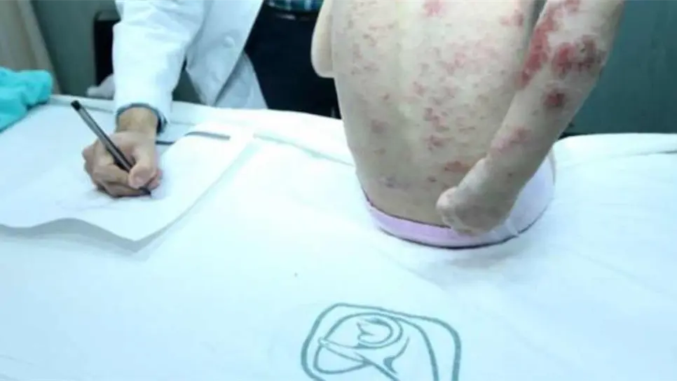 Choix, municipio con más casos de lepra en todo Sinaloa