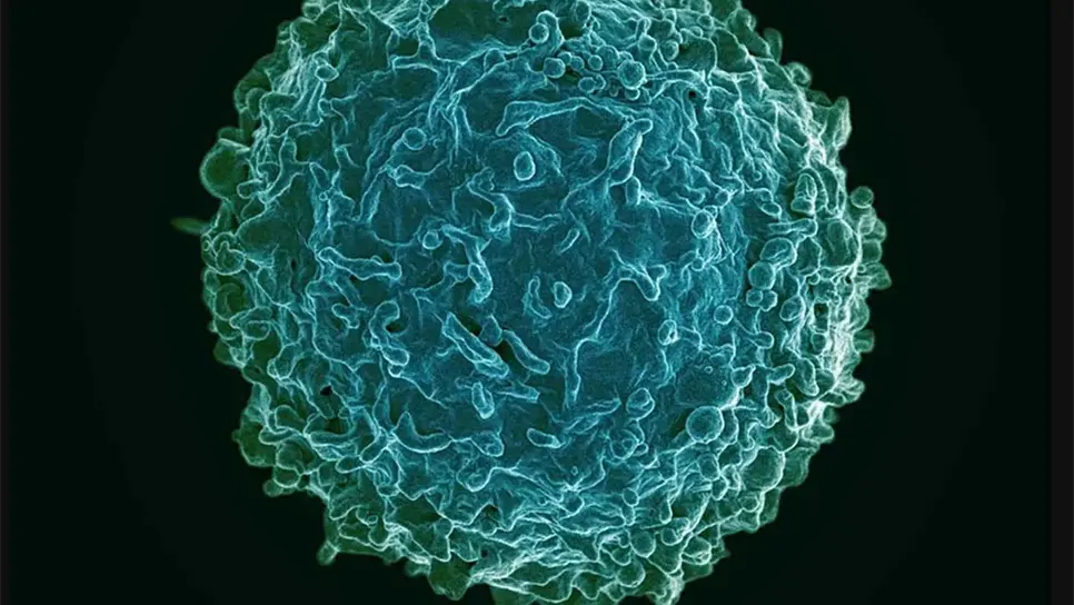 Leucemia mieloide es cada vez más frecuente en pacientes jóvenes en México