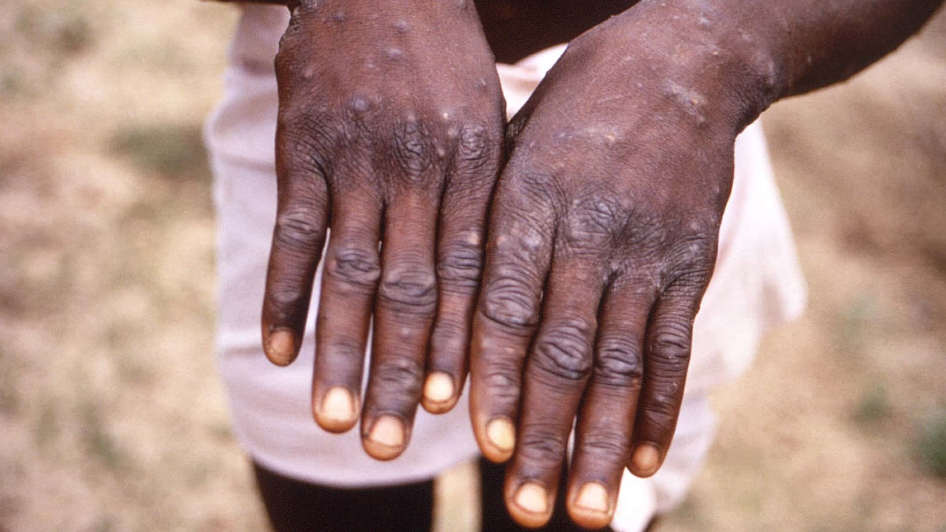 Estos son los síntomas de la Viruela del Mono
