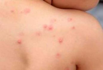Durango pide a estados con casos de Viruela del Mono que compartan su manejo de la enfermedad