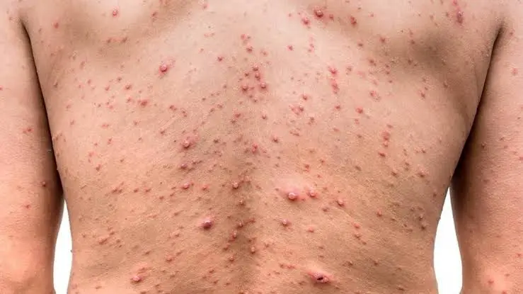 Sector Salud confirma caso positivo a Viruela del Mono en Sinaloa