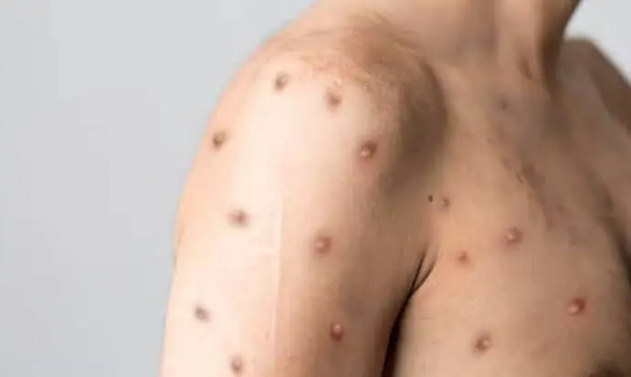 Dan positivo 3 nuevos casos a Viruela del Mono en Mazatlán