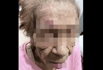 Denuncian negligencia en asilo por heridas graves a abuelita