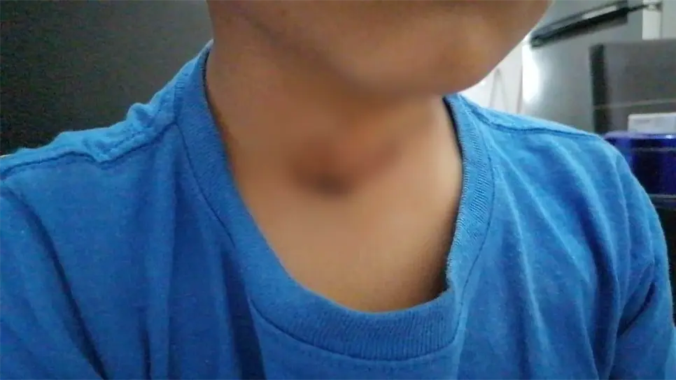 El niño requirió puntadas en gran parte del cuello y oreja. FOTO: Cortesía