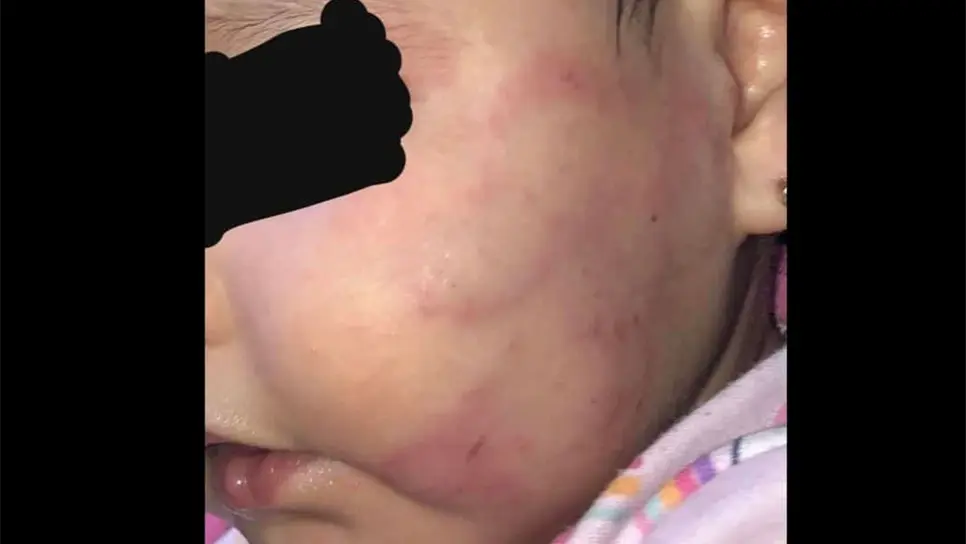 La versión de las niñeras fue que los golpes se los hizo otro bebé. FOTO: Cortesía