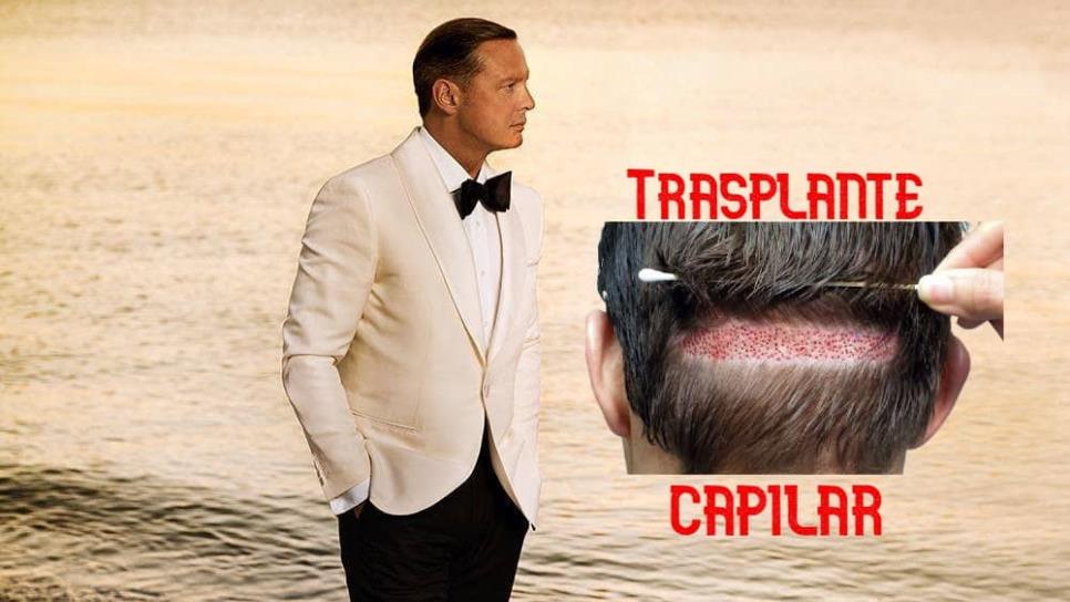 Luis Miguel se trasplanta cabello y luce nueva imagen Luis Miguel se trasplanta cabello y luce nueva imagen