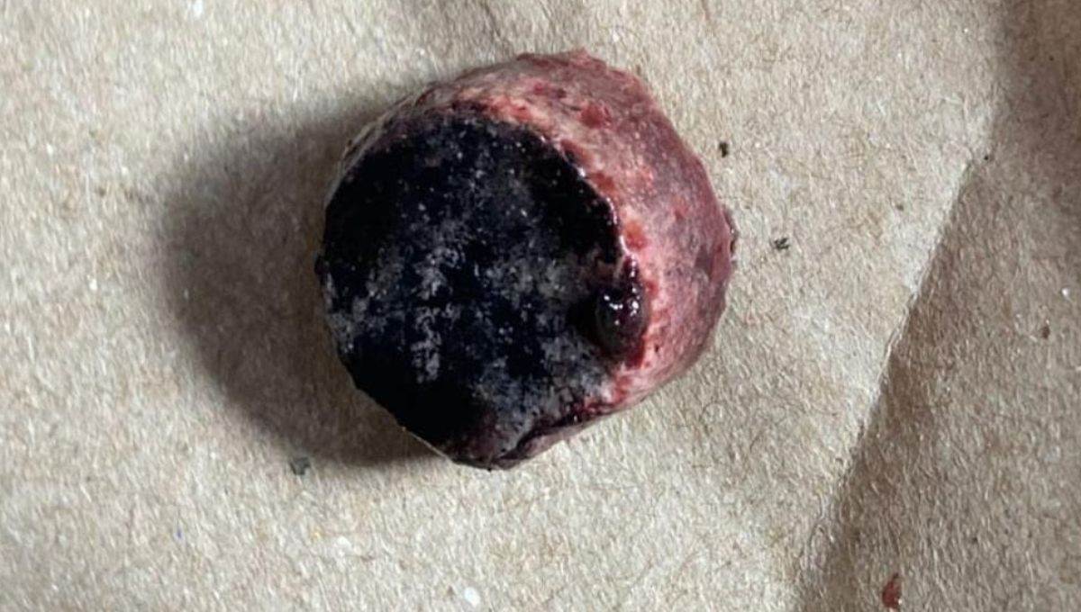 El pedazo de cuete que le sacaron del cachete a la niña.