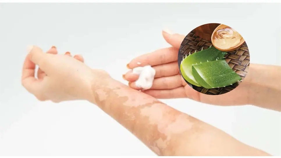 Remedios caseros contra quemaduras que sí funcionan. | FOTO: Temática.