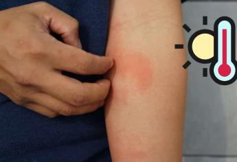 ¿Qué hacer si te da sarpullido por el calor? Causas y síntomas
