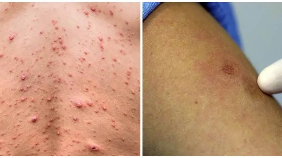 FOTO: Viruela del mono.