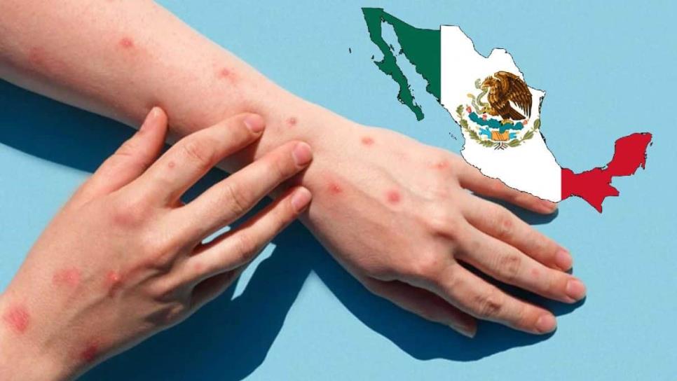 Mpox en México: ¿Cuántos casos hay y en qué estados?