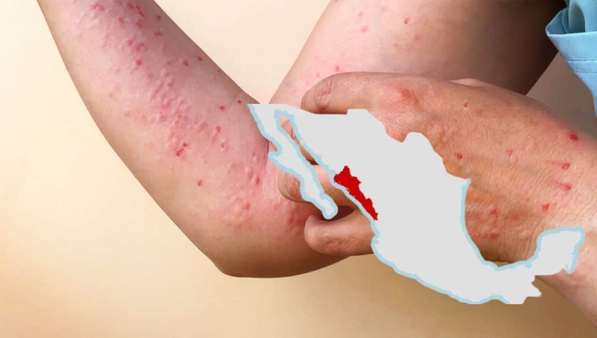 El mpox es altamente contagioso. FOTO: Internet