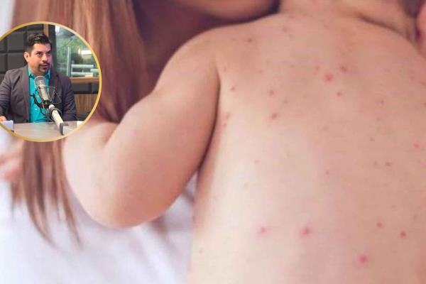 Alertan a sinaloenses que viajen a Estados Unidos por brote de Sarampión