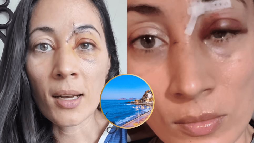 Patín eléctrico embiste a mujer en la ciclovía del Malecón de Mazatlán; casi pierde un ojo