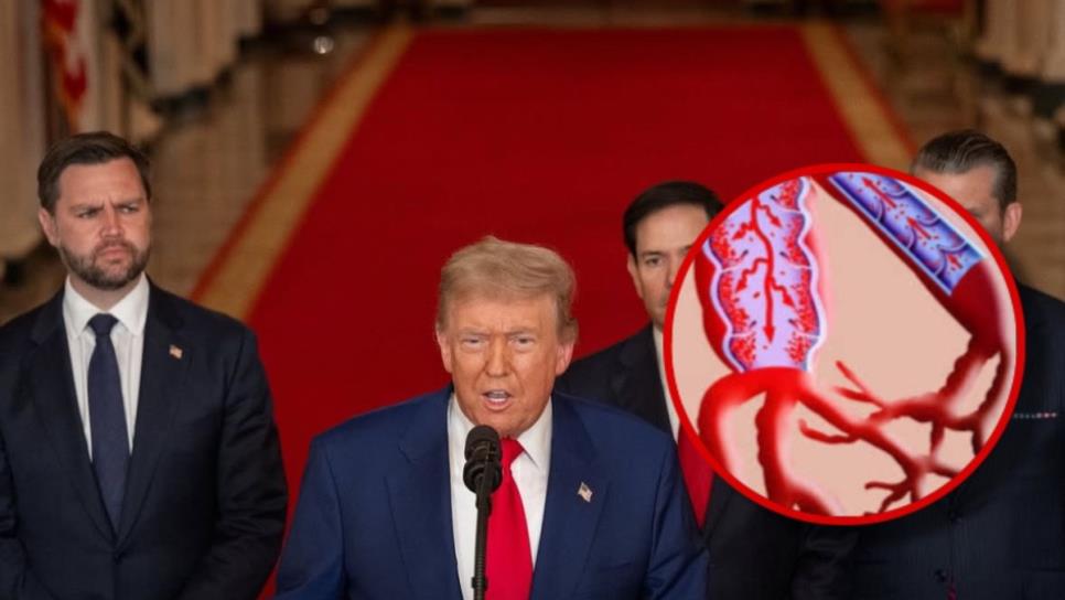 Insuficiencia venosa crónica: ¿Qué es la enfermedad que padece Donald Trump?