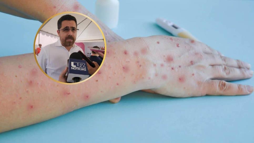 Suman 9 casos de sarampión en Sinaloa: se mantienen controlados y en vigilancia domiciliaria