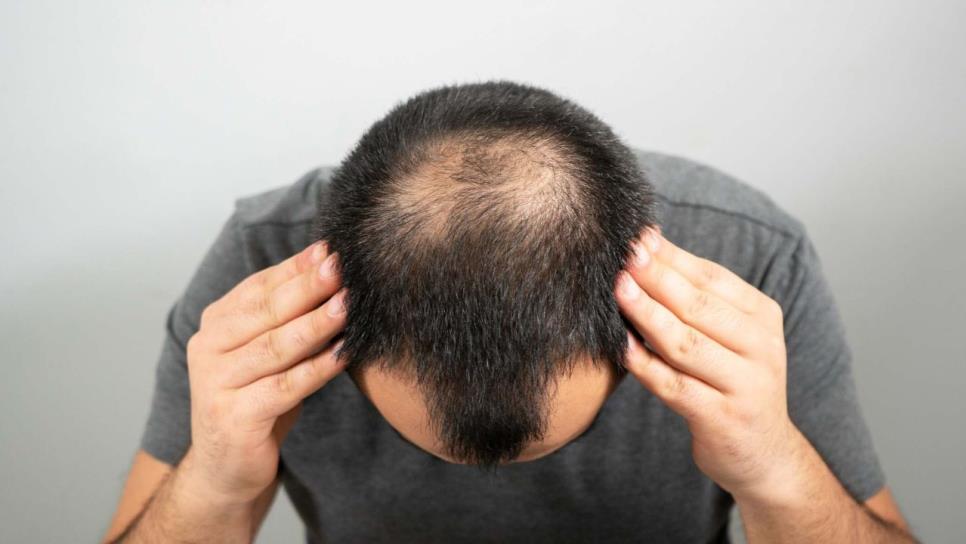 ¡Adiós a la calvicie! descubren tratamiento que promueve el crecimiento del cabello de manera seguro