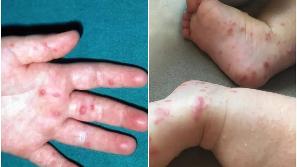 FOTO: Brote del virus Coxsackie provoca suspensión de clases en estos municipios