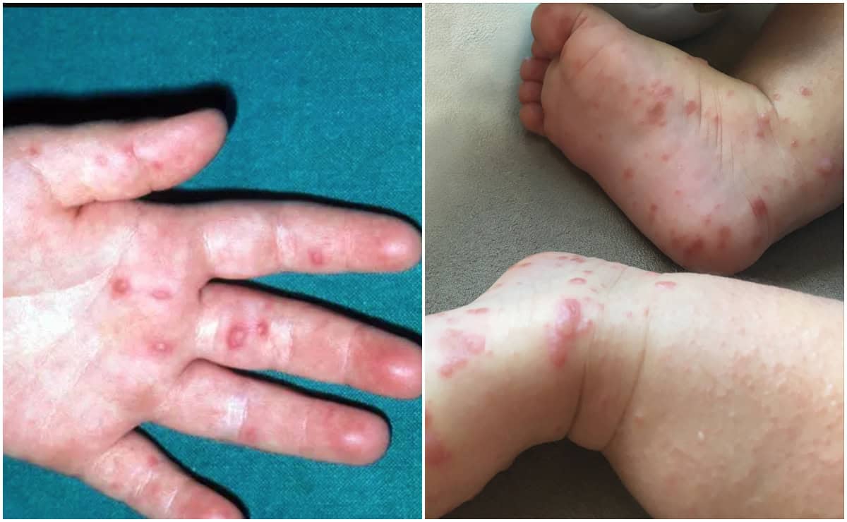 Brote del virus Coxsackie provoca suspensión de clases en estos municipios