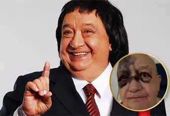 ¿Qué le pasó a Luis de Alba ‘El Pirrurris’? El comediante reapareció irreconocible tras fuerte accidente