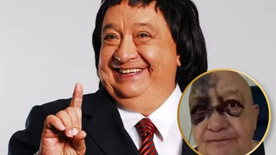 ¿Qué le pasó a Luis de Alba ´El Pirrurris´? El comediante reapareció irreconocible tras fuerte accidente